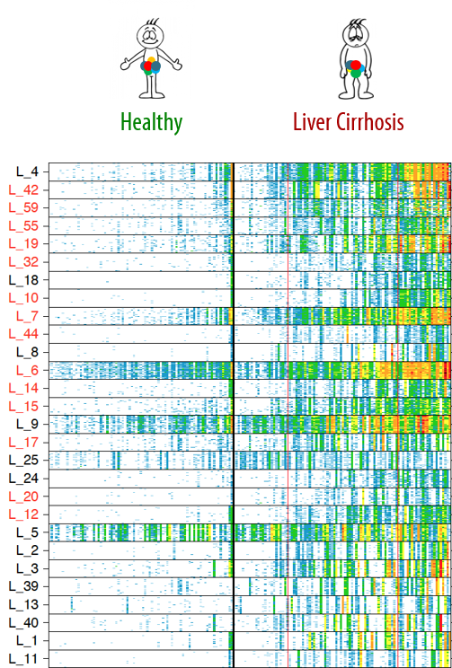 Human gut microbiome alterations in liver cirrhosis